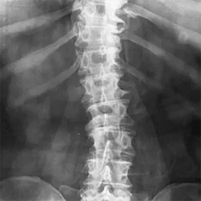A digital x-ray of a patient's spine with scoliosis